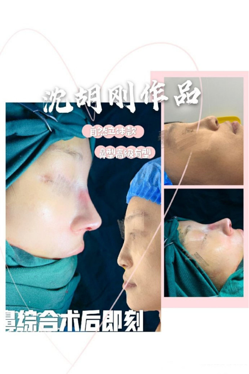 鼻部多项手术案例