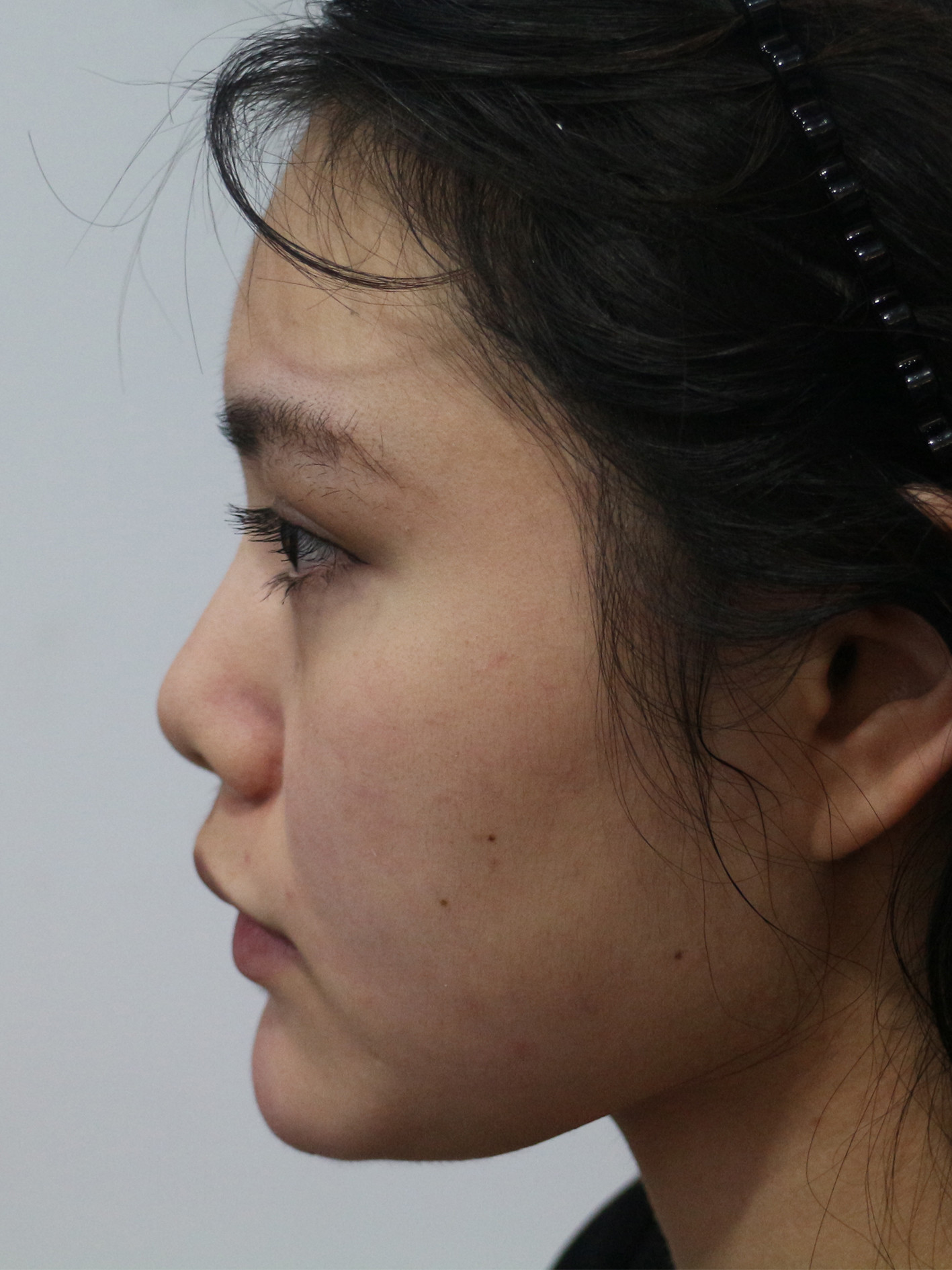 短鼻是这个小姑娘最明显的问题,鼻根过低,鼻起点靠下,在鼻型受到影响