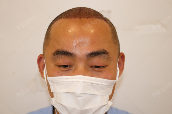 种植发际线项目术后第二天常州百年植发