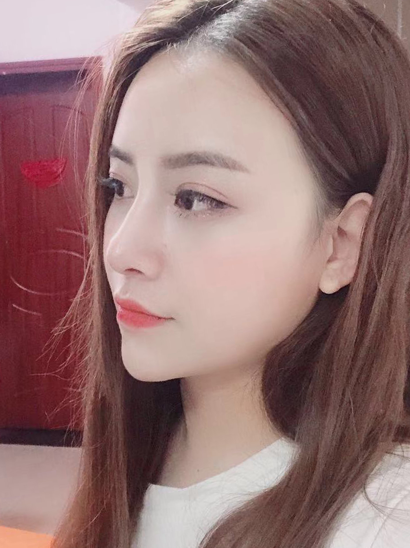 线雕鼻来修复,首先要做的就是把线体取出,但因为线雕_圈子-新氧美容