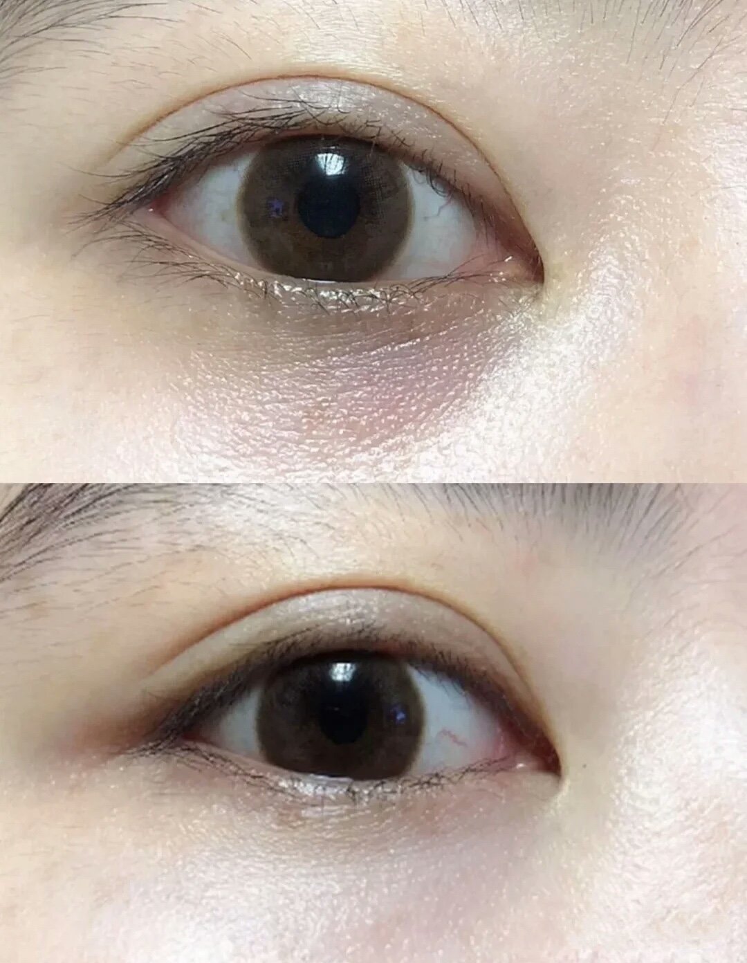 全切双眼皮前后对比,差距太大了