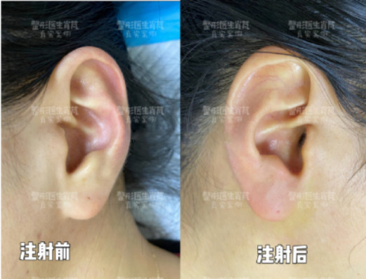 项目:乔雅登雅致玻尿酸注射耳垂修饰姑娘喜欢丰满的耳_圈子-新氧美容