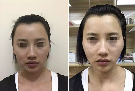 看脸部线雕后当天的照片,惊问线雕后脸变宽能恢复吗?