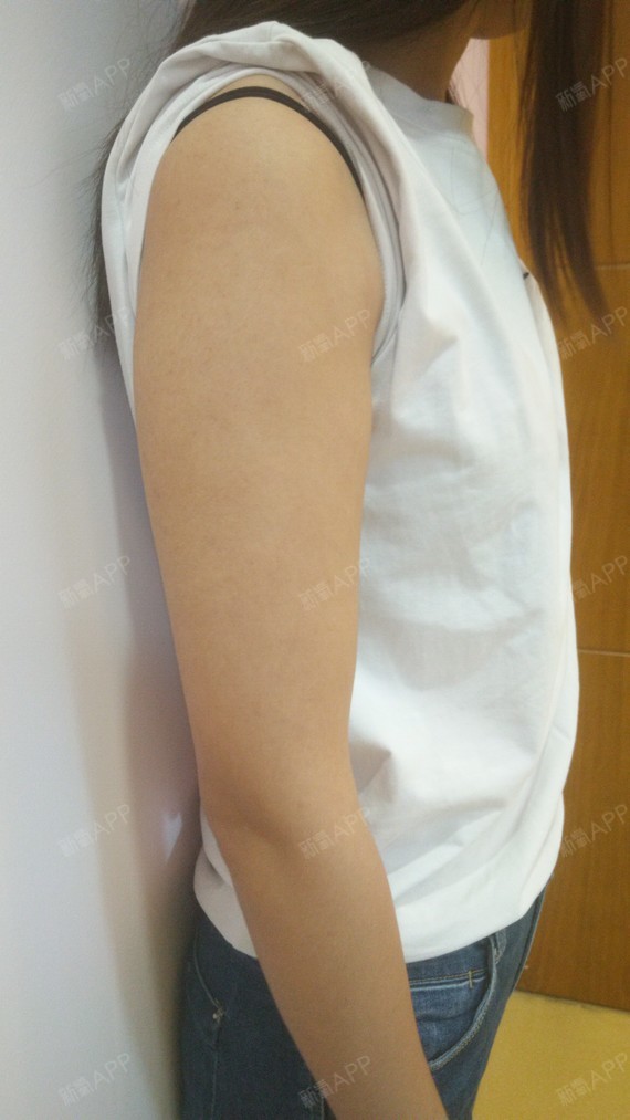 【宝丽太手臂吸脂】【广州艺美张涛院长】