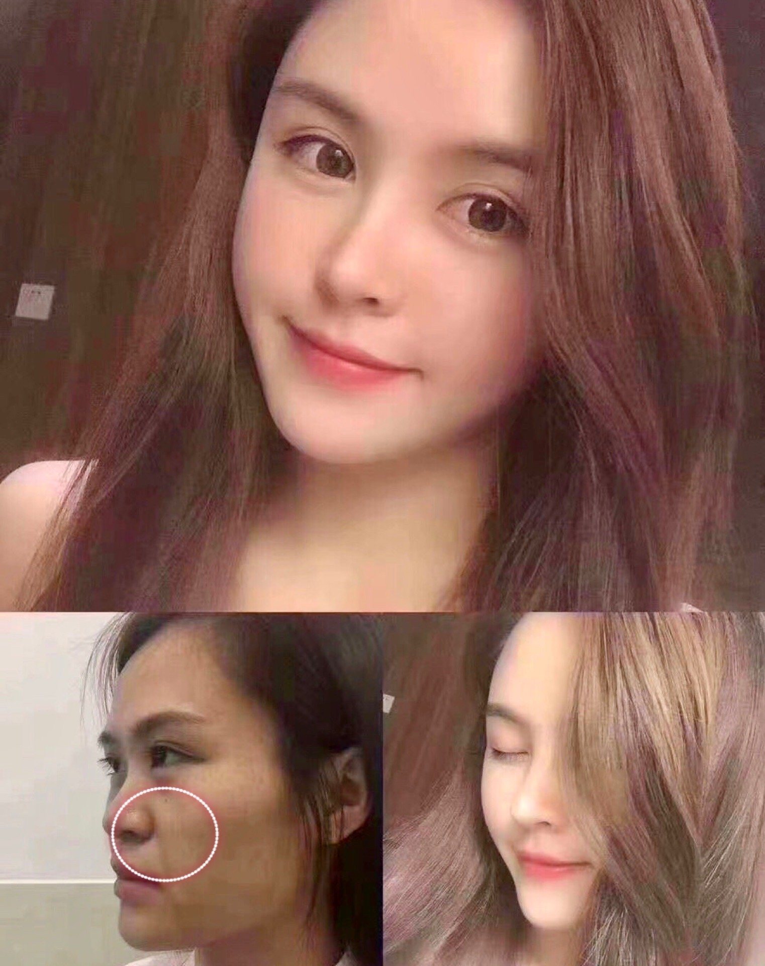 避坑鼻基底真的不要随便填!