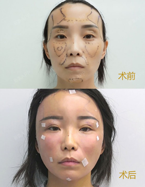 眼窝凹陷非常显老,想通过自体脂肪填充眼窝,效果会好_圈子-新氧美容