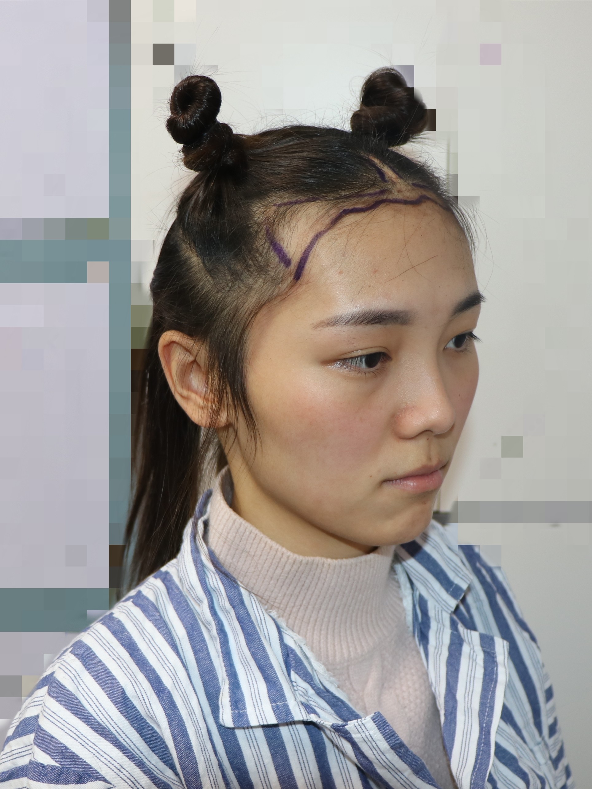 疤痕植发视频(疤痕植发的成活率)