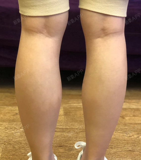小腿粗,腿肚子的肉鼓鼓的一坨,穿裙子和裤子显得腿可_圈子-新氧美容