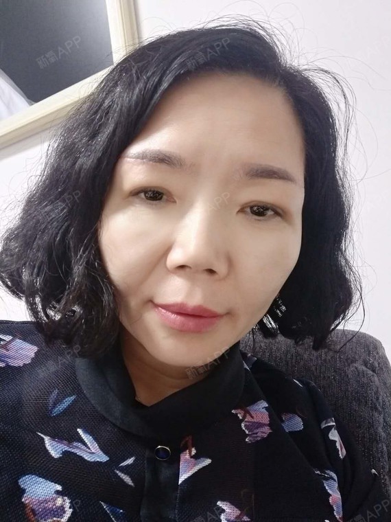 提眉时间过得可真快,恢复的差不多了,眼部改善的太多了,特别感谢凳北