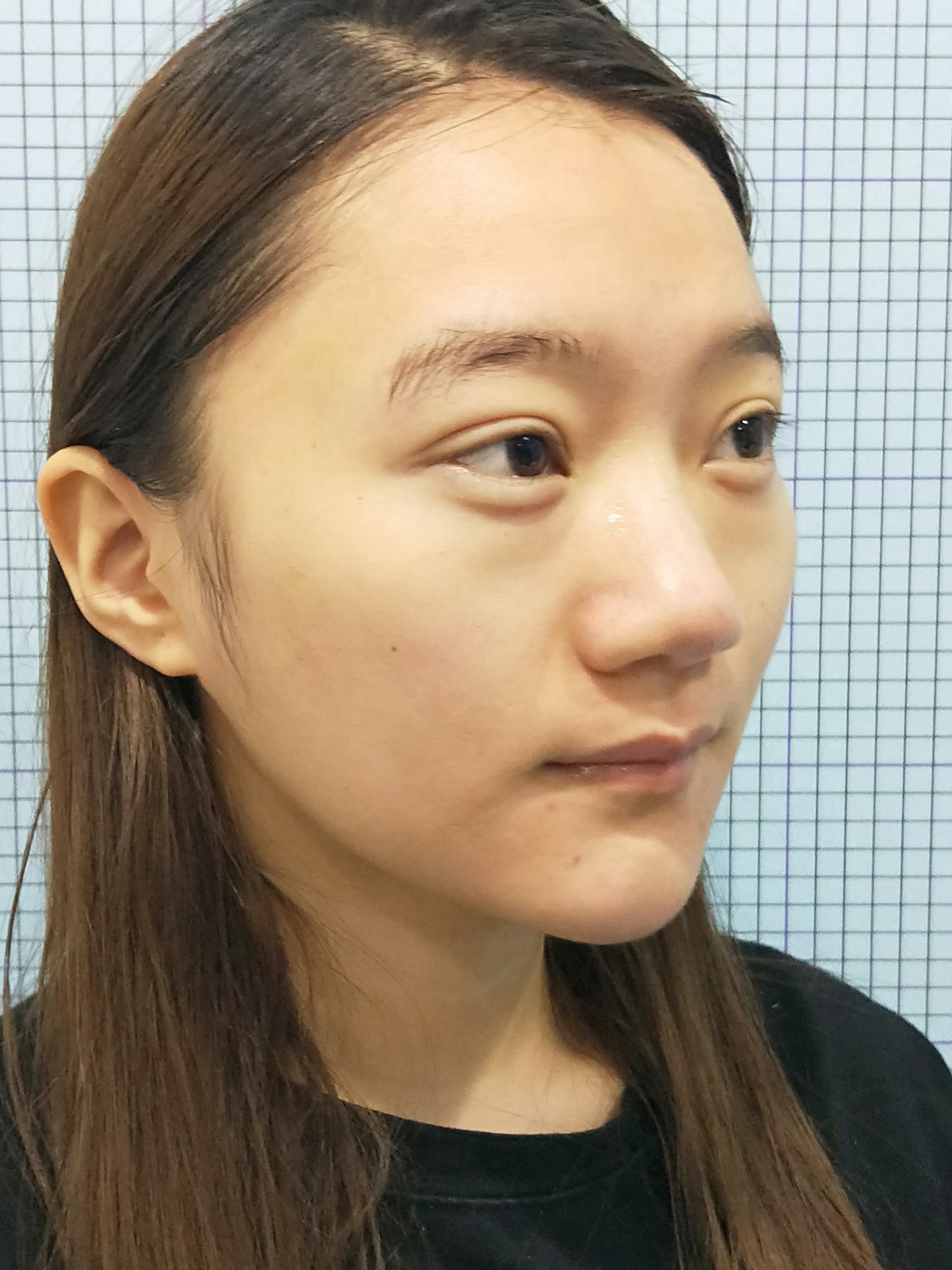 宽鼻,短鼻,是这个女生最明显的鼻部问题,想要鼻形变好看就需要抓住这