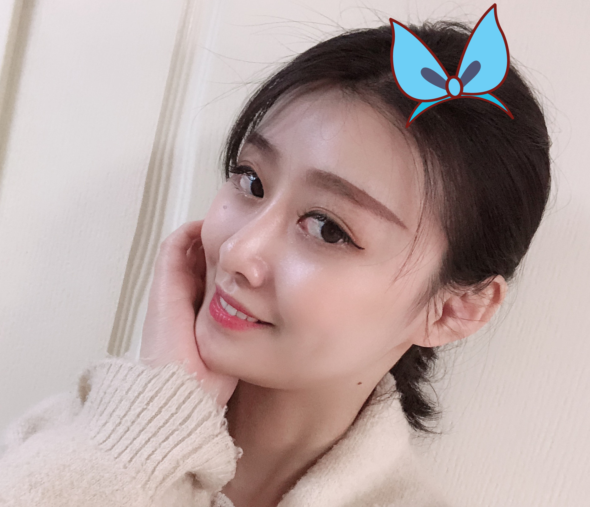 93鼻基底让我的年龄感,完全小了好几岁,鼻基底填充后_圈子-新氧美容