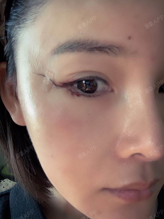 外眼角下至术后第一天