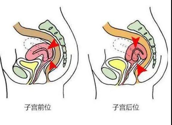 是临床上比较常见子宫位置,包括子宫后倾和子宫后屈.