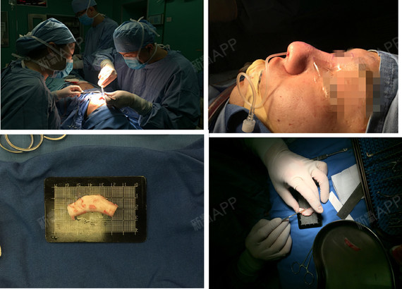 膨体垫鼻梁,鼻尖塑形,修复鼻肥大并衍生一系列问题,包括鼻甲肥大,鼻部