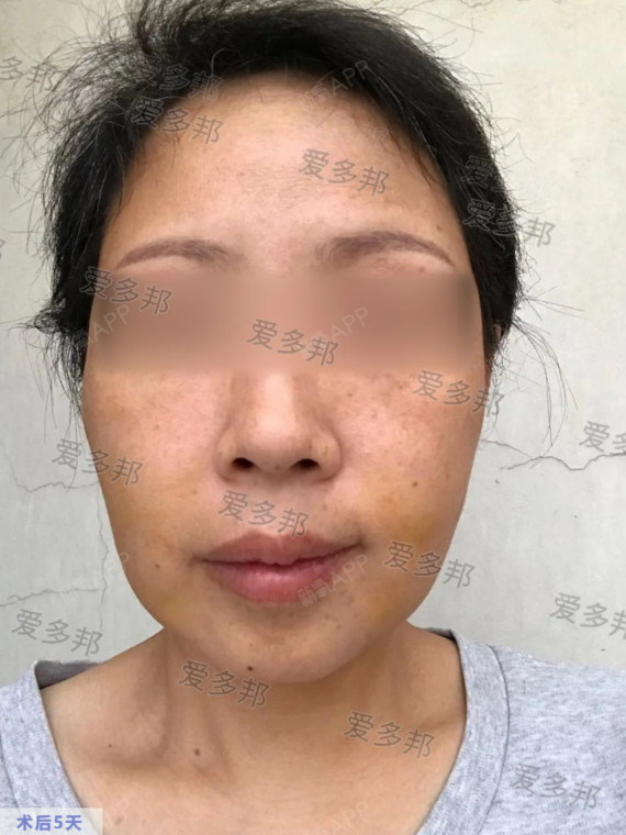 面颊爱贝芙取出---因为年轻的时候长的比较瘦,脸颊_圈子-新氧美容整形