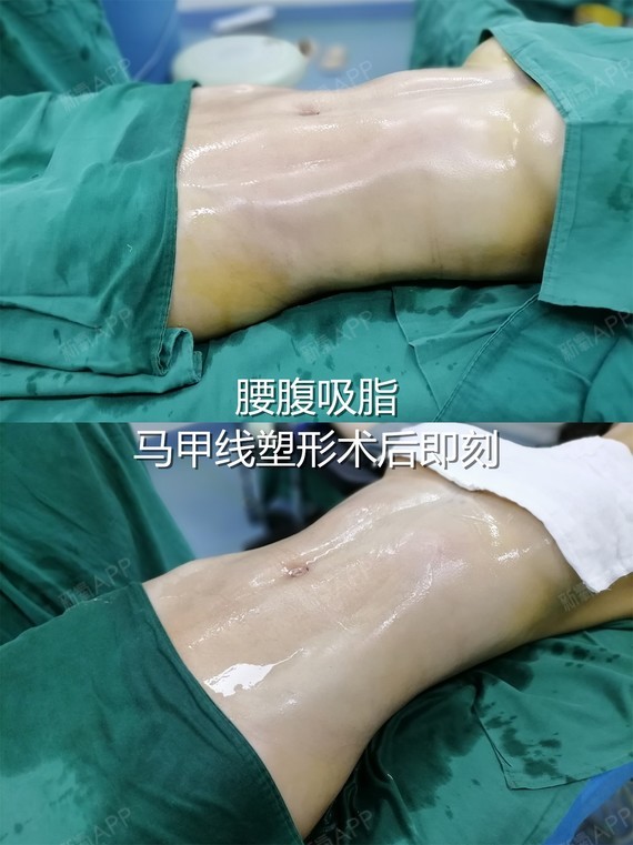 腰腹吸脂 马甲线塑形术后第2天