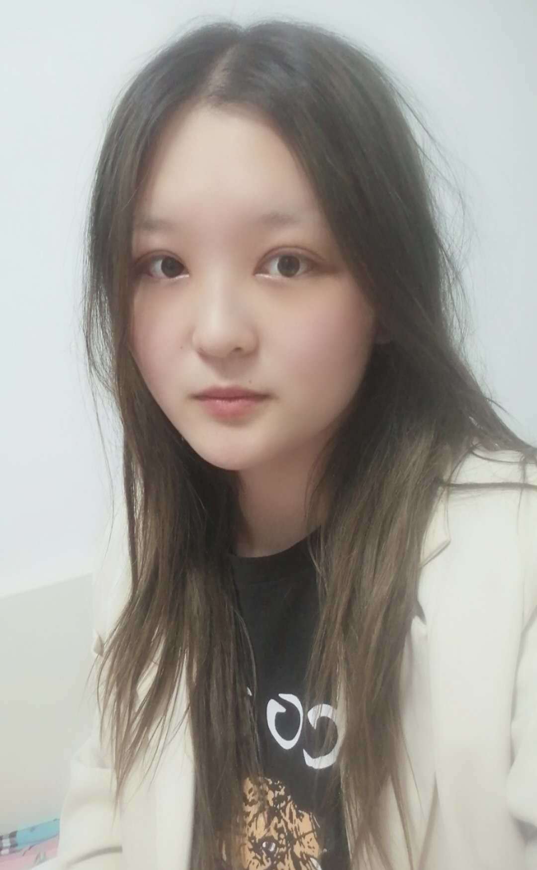 双眼皮手术/术后10天