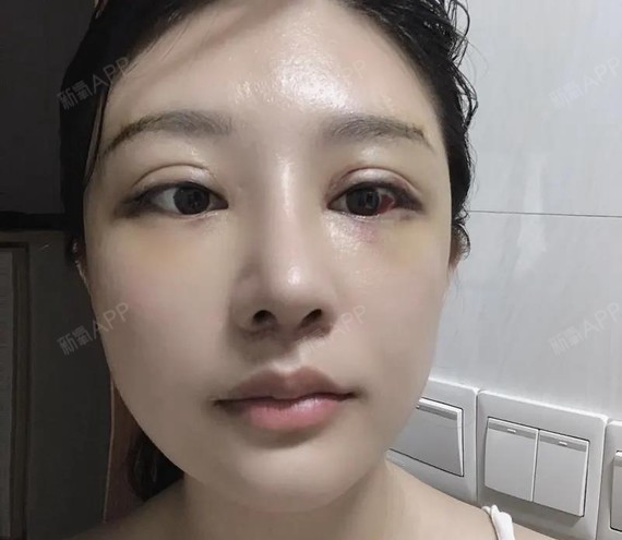 假体眉弓