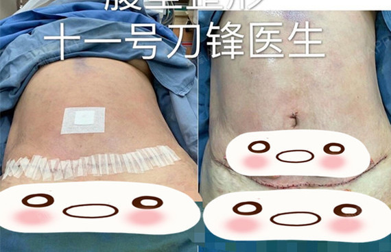 手术方案:腰腹环吸 全腹壁成形,全腹壁成形包含分离腹直肌缝合,切除