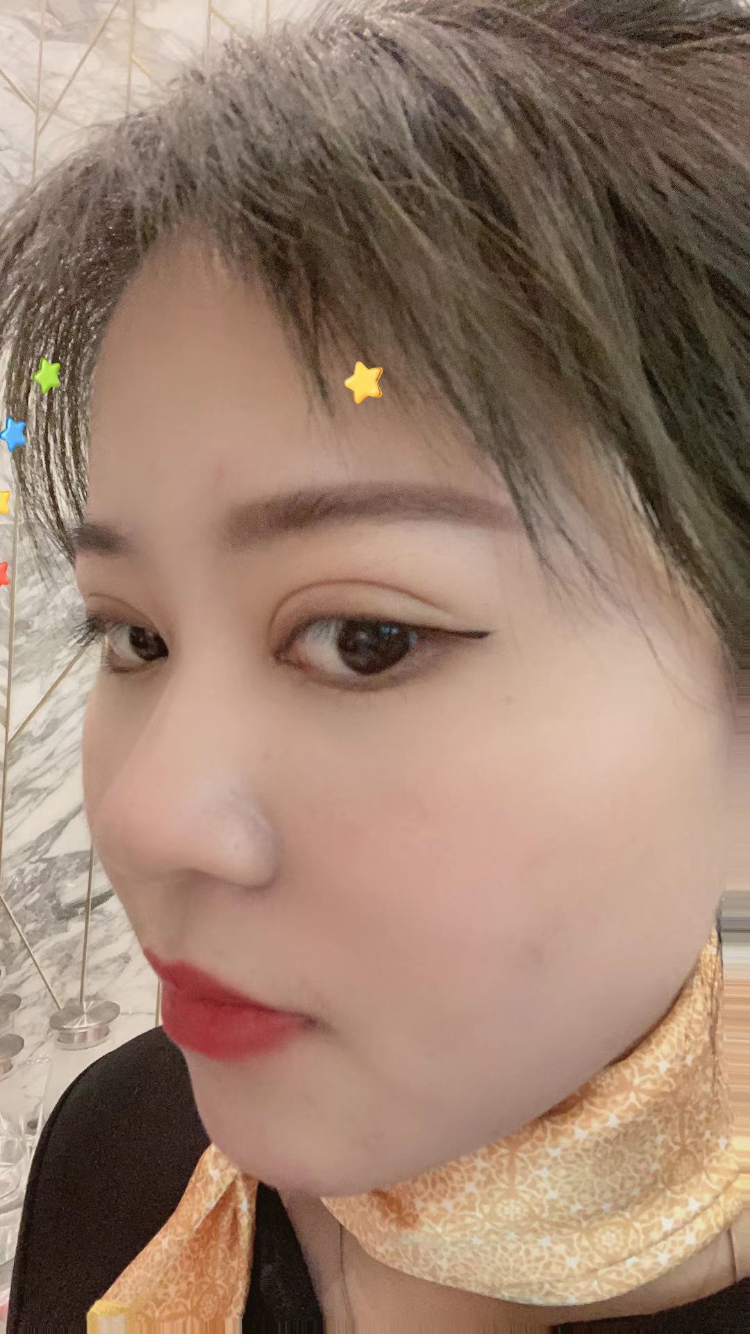 艺星美杜莎美眼部多项 术后15天】做完双眼皮两周_圈子-新氧美容整形