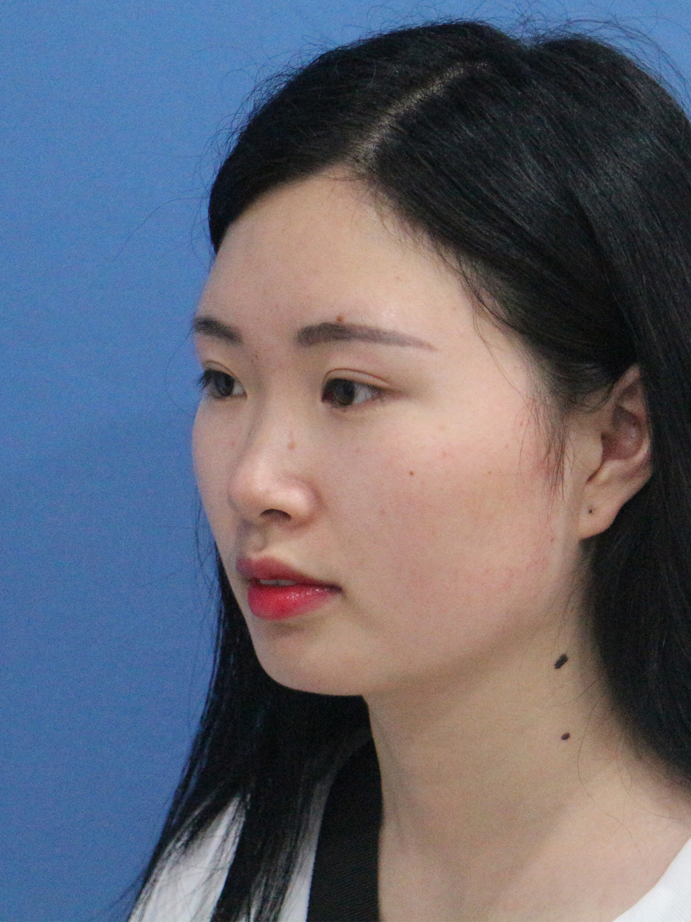 93鼻根低,没鼻尖,低鼻子确实会显得面部凹陷,没元气_圈子-新氧美容