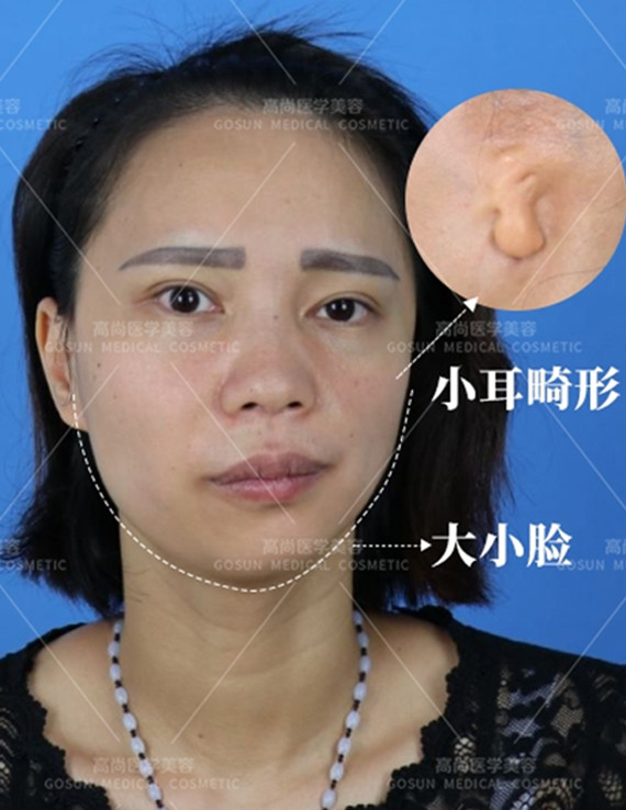 这是一名典型的先天性小耳畸形合并半面短小症的女性患者,也是头面部