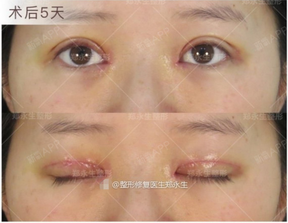 常的,在6个月的时候逐渐趋于自然,闭眼痕迹也非常隐蔽良,且瞳孔暴露不