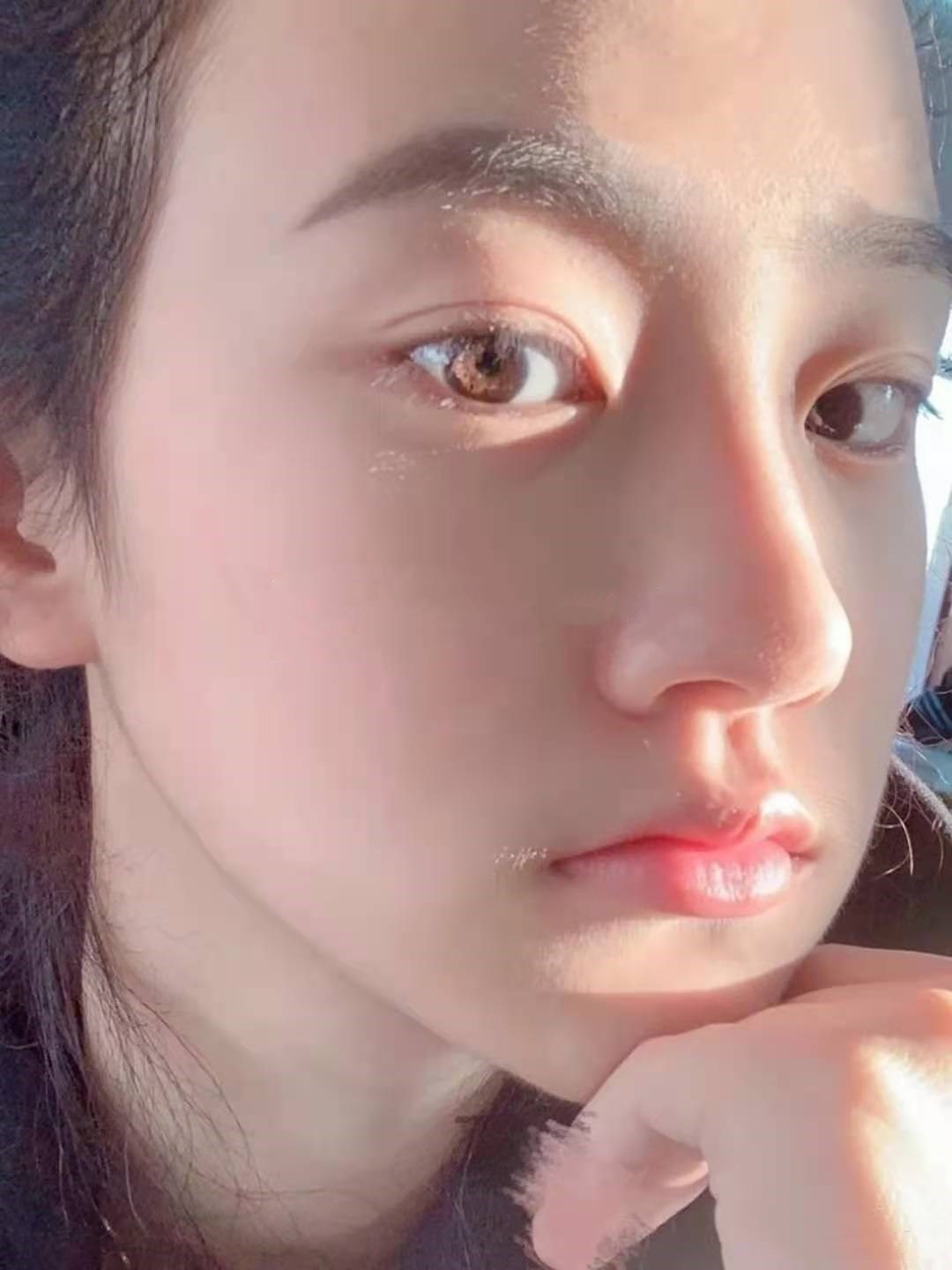 7mm全切双眼皮!真实记录恢复的敲自然