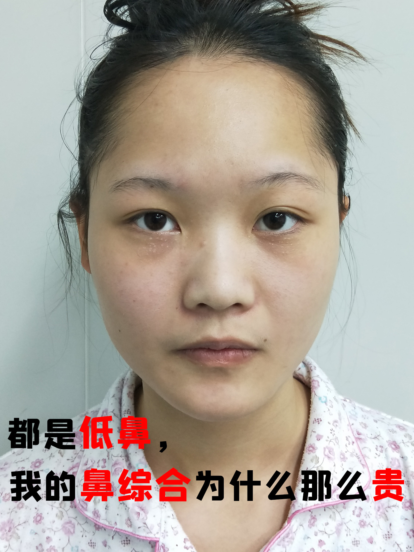 低鼻分三种:鼻根低,鼻背低以及鼻头低,但每一种低鼻的情况又各不相同