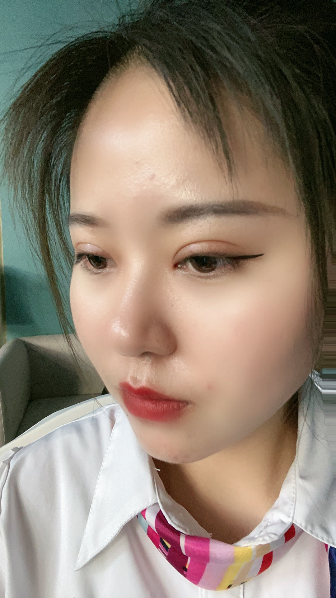 【艺星美杜莎双眼皮术后30天】