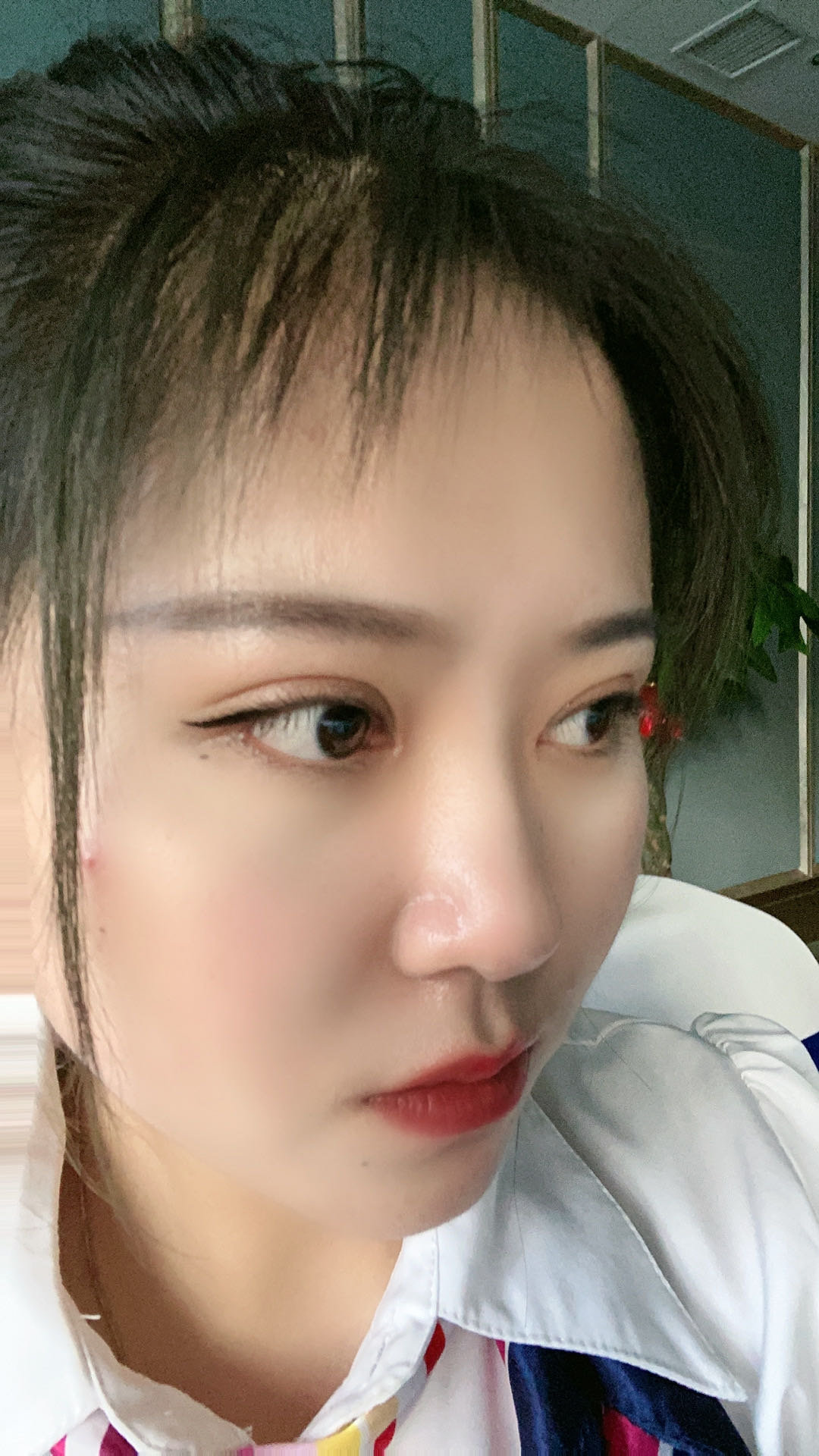 最近开始涂祛疤膏了,希望能够恢复的好一些~ 目前感觉双眼皮的弧度和