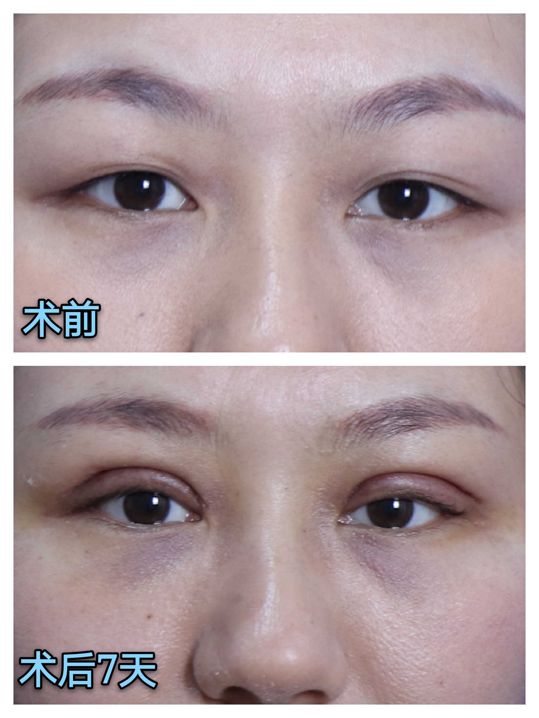 重睑术案例分享