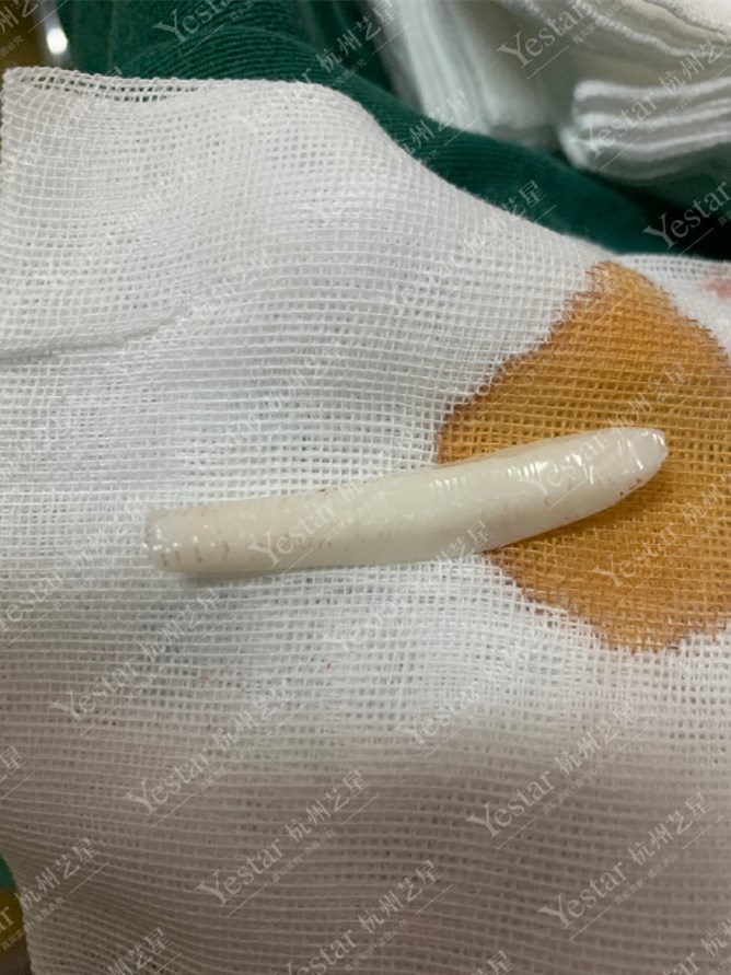 手术取出的硅胶假体.
