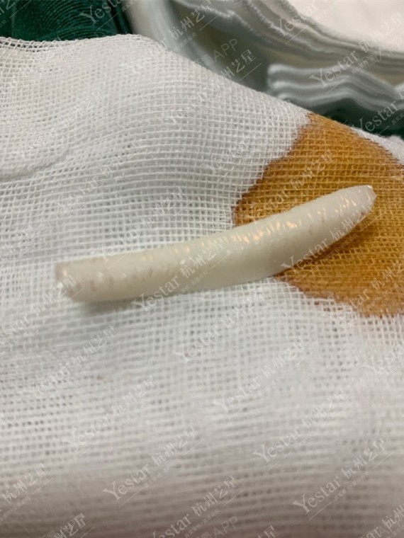 手术取出的硅胶假体.