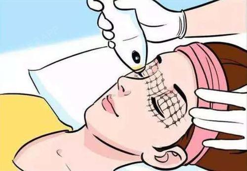 知否冰电波拉皮效果怎么样,冰电波拉皮多久做一次答案真实