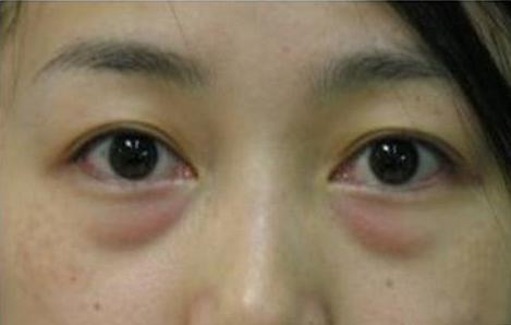泪沟明显还有眼袋,到底是填泪沟还是做眼袋?