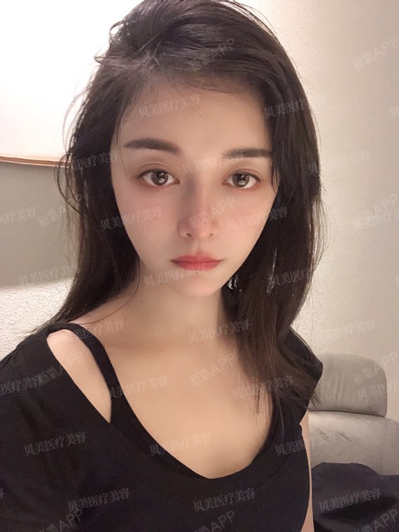 耳软骨鼻部多项 宽鼻缩窄 鼻基底填充 自体脂肪填充面_圈子-新氧美容