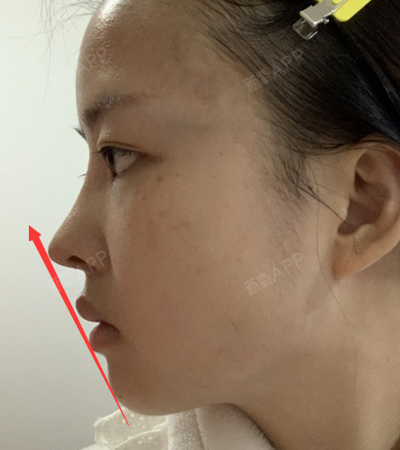 从你的侧脸这个鼻子是非常好的,看下图1,鼻尖嘴唇下巴3点一线,可以说