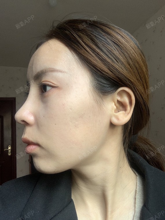 鼻翼基底凹陷是不是一定要填