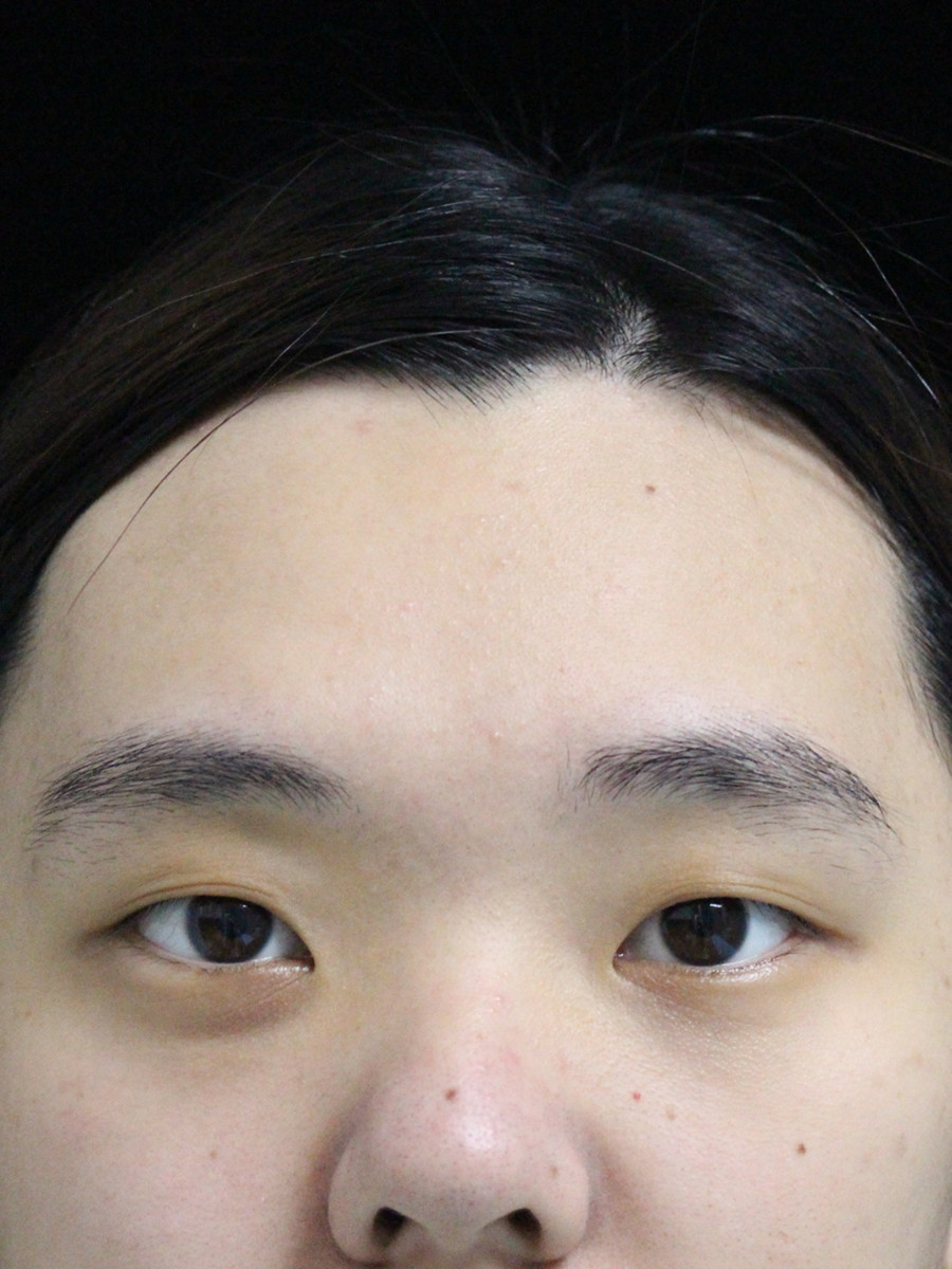 有人问:我的两眼间距不宽,为什么还要开内眼角?