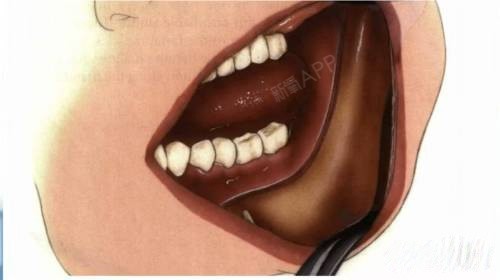 下颌角手术,分三种情况,也就是有三种手术方式 每种手术方式的切口