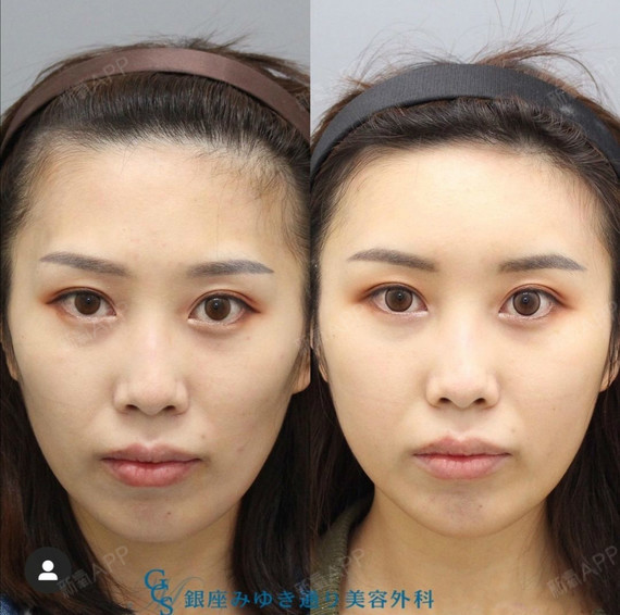 太阳穴,脸颊下方进行【高浓缩脂肪填充】的案例 #面部脂肪填充