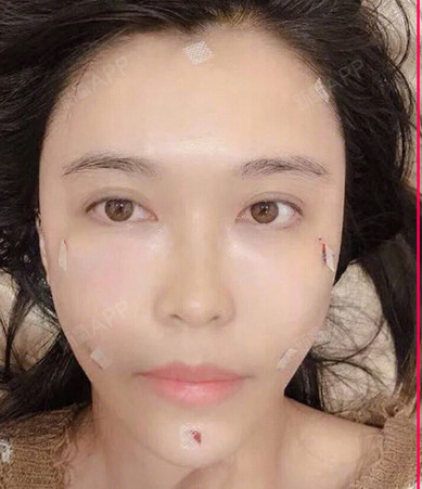 丑女线雕恢复日记,全脸线雕前后对比照片不敢相信?