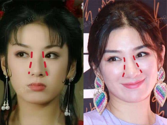 这些明星做错了什么71鼻子会越来越宽71不知从何时开始_圈子-新氧