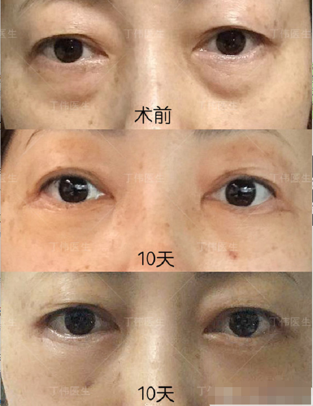 今天分享个外切眼袋 眶隔释放的案例.