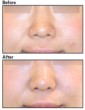 02【案例分享】肉毒素缩鼻翼患者对笑起来的时候鼻翼想_圈子-新氧