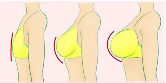 医美科普:假体隆胸手术切口的不同位置