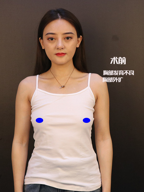 使胸部变大成型,实现二次发育"以假乱真",还免去了多次丰胸未果的烦恼