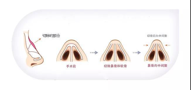 91駝峰鼻,一般表現為鼻樑稍寬,且向前突出為折角