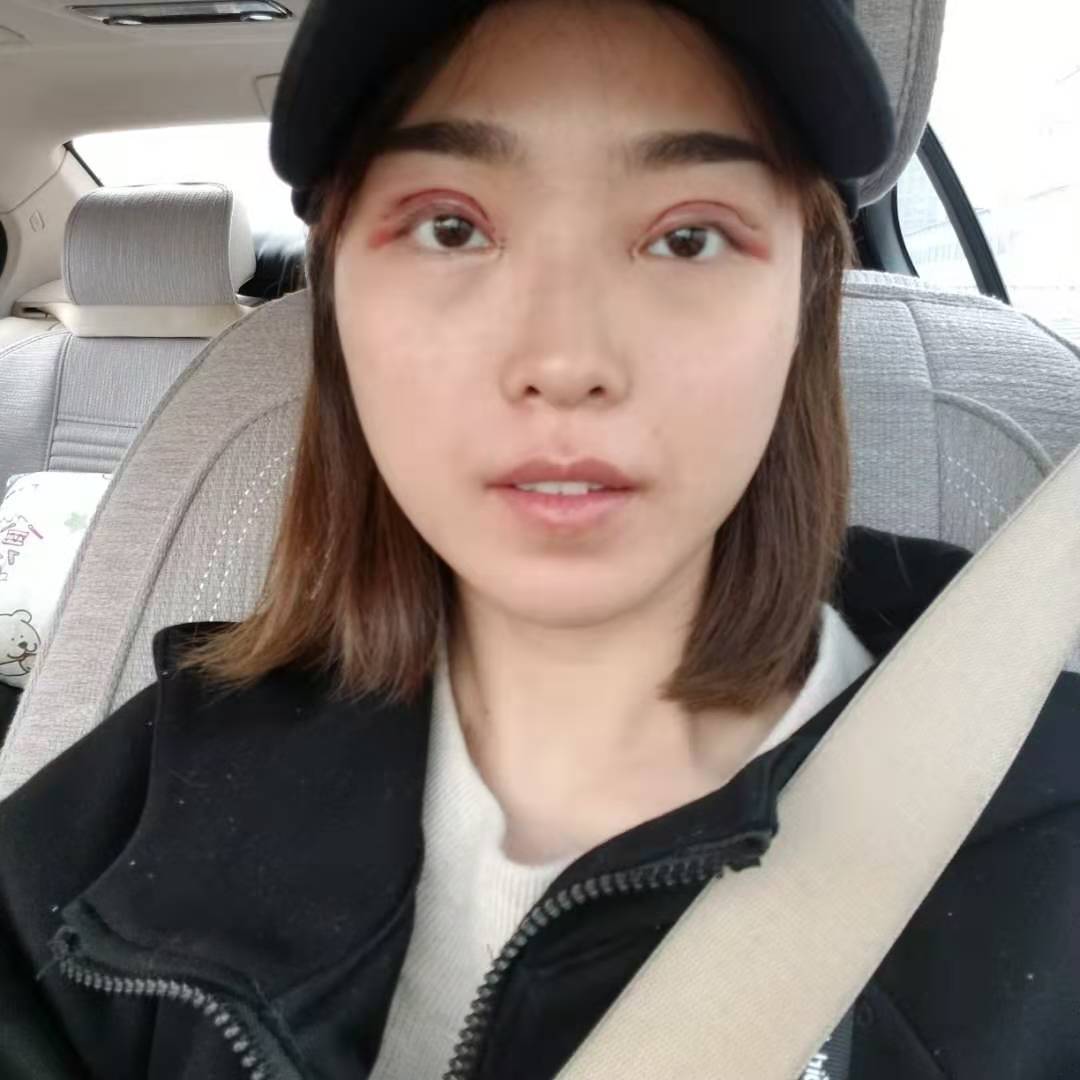 今天是做完双眼皮手术的第三天
